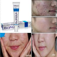 BIOAQUA Anti Acne Cream – Acne Treatment & Scar Removal Formula